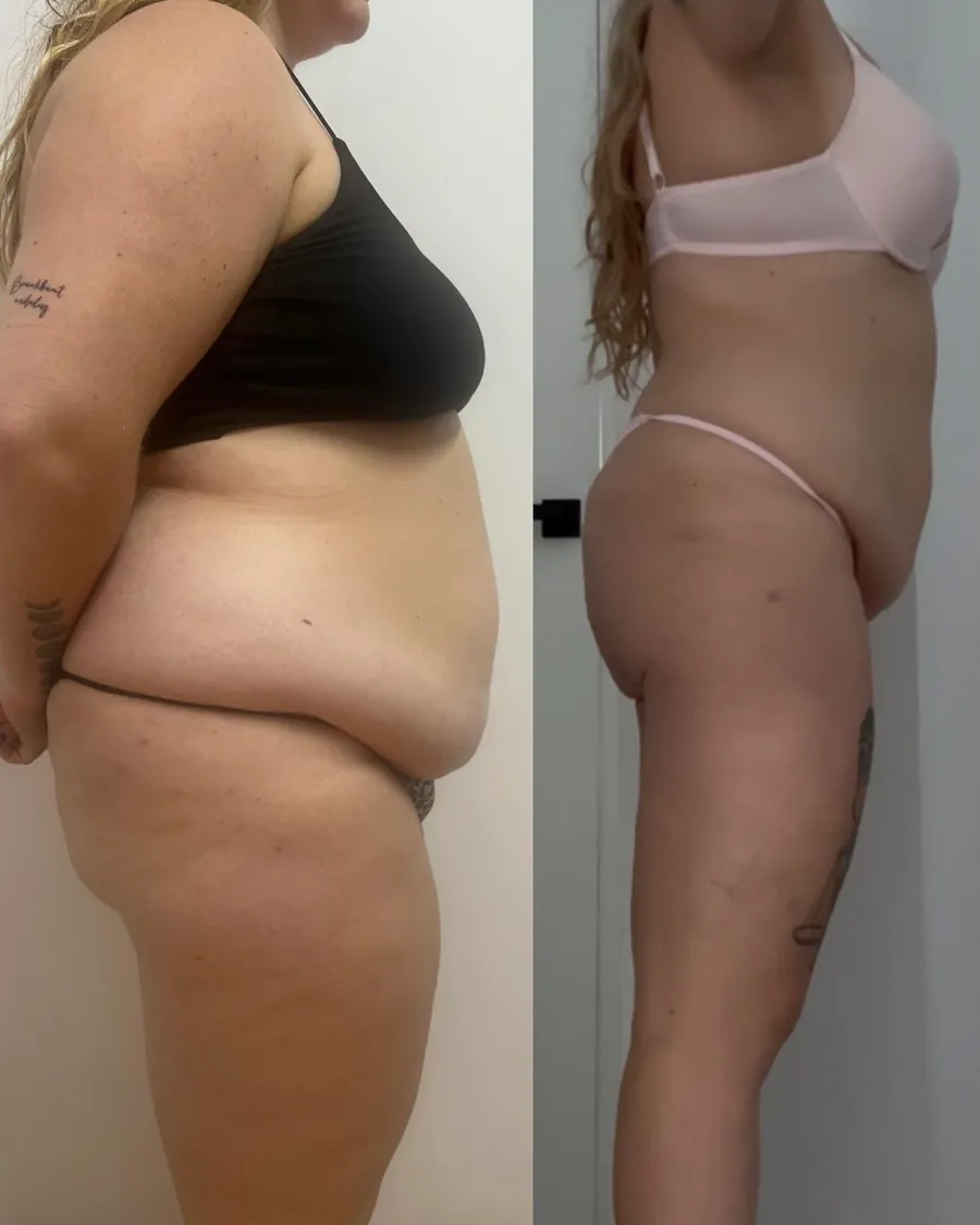 Antes y después de Laura P.